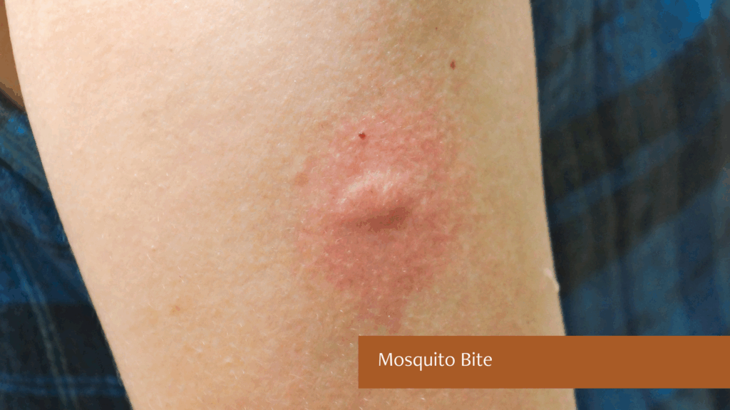 mosquito bite
