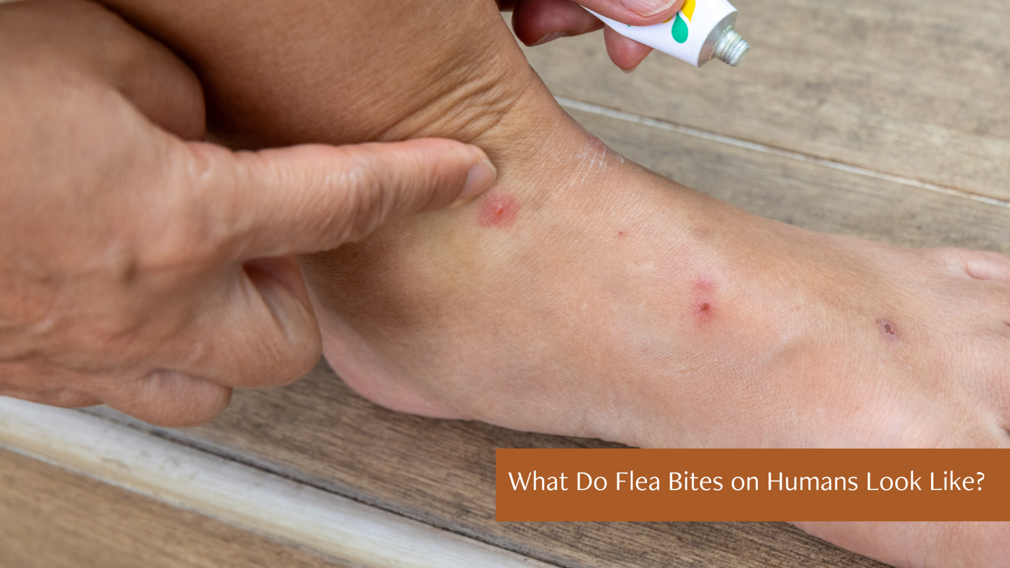 Flea Bites On Humans Easy Ways To Identify Treat And Prevent Them 